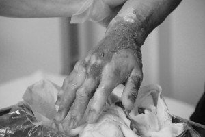 1・水泡膜除去後jpg02