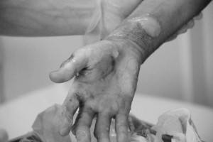 2・水泡膜除去後jpg01