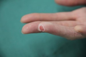 40歳 女性 右第４指皮膚欠損創経過1