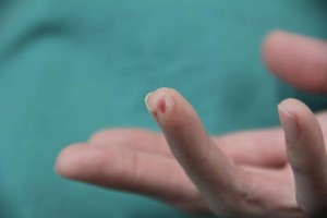 40歳 女性 右第４指皮膚欠損創経過−２